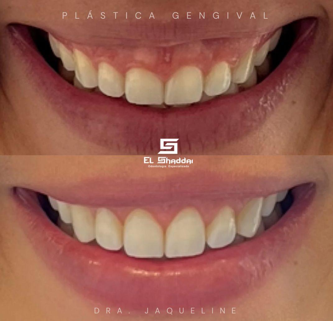 Plástica Gengival — Dra. Jaqueline