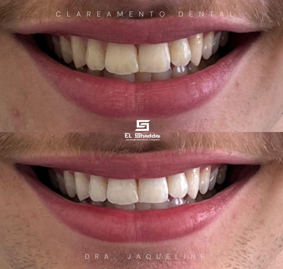 Clareamento Dental — Dra. Jaqueline