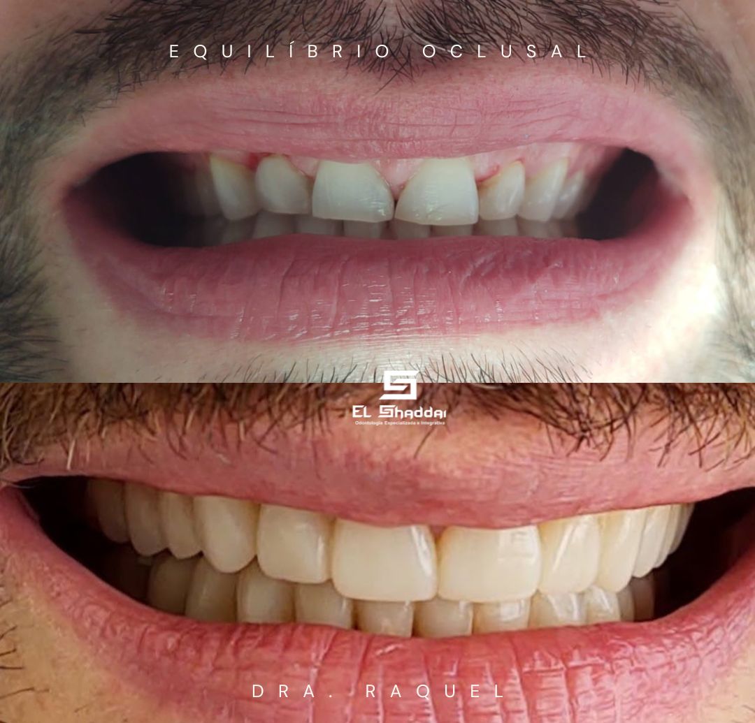Equilíbrio Oclusal — Dra. Raquel